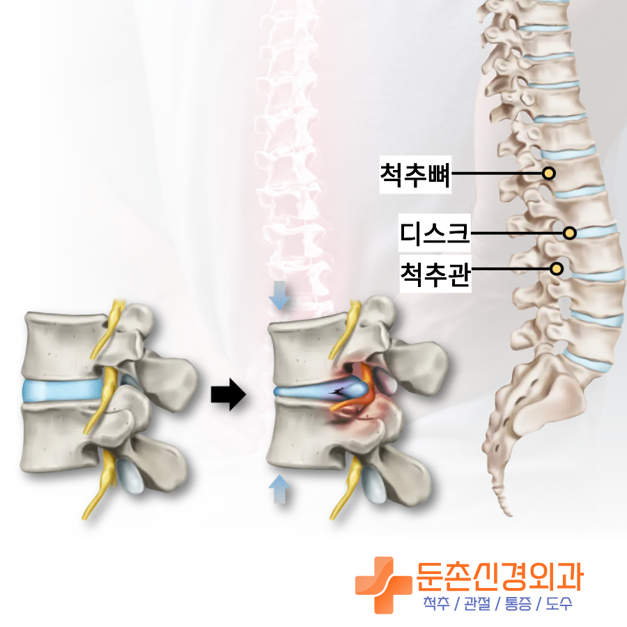 둔촌동 허리디스크 척추 디스크 신경 구조
