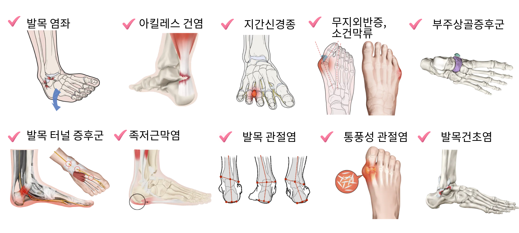 둔촌동 둔촌동역 성내동 족부질환 올림픽파크포레온  길동 족부정형외과 발목염좌 족저근막염 발바닥통증 등