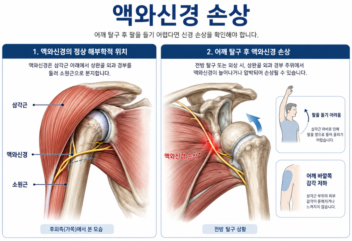 액와신경손상 액와신경포착증후군