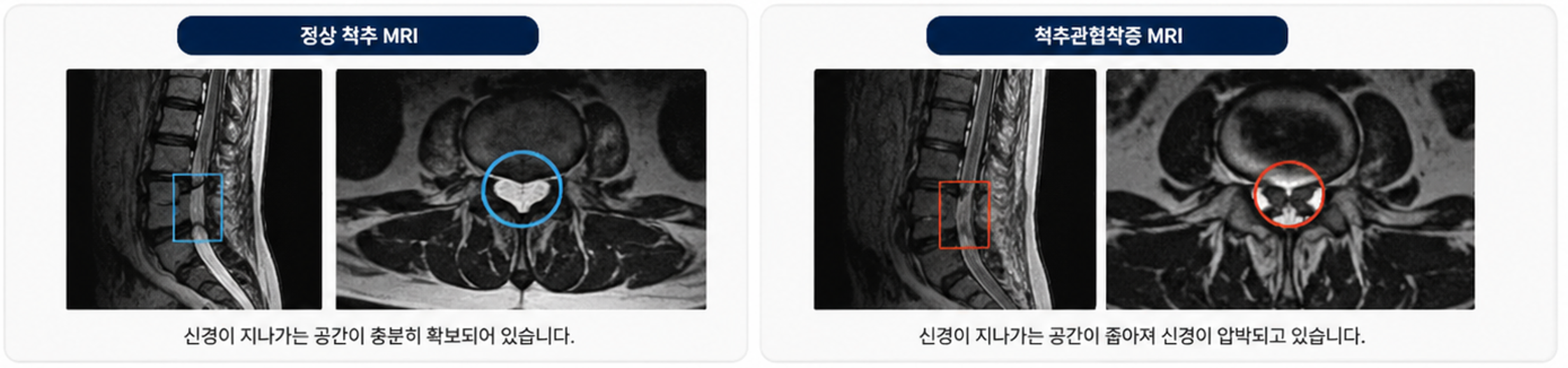 척추관협착증 MRI 검사