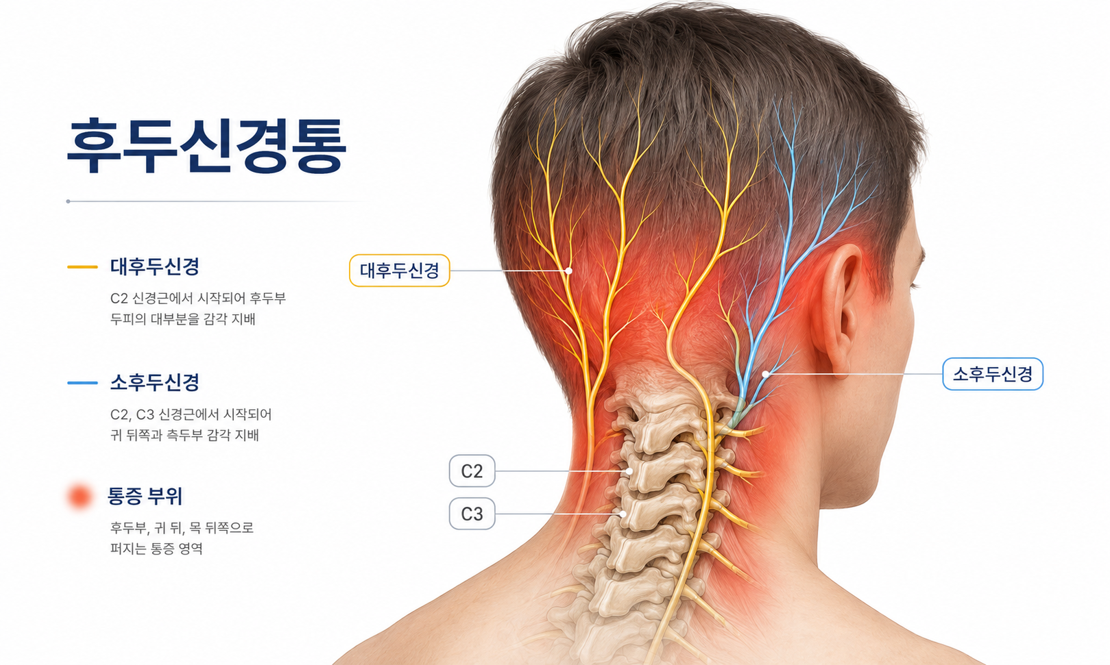 후두신경통 통증 위치 이미지