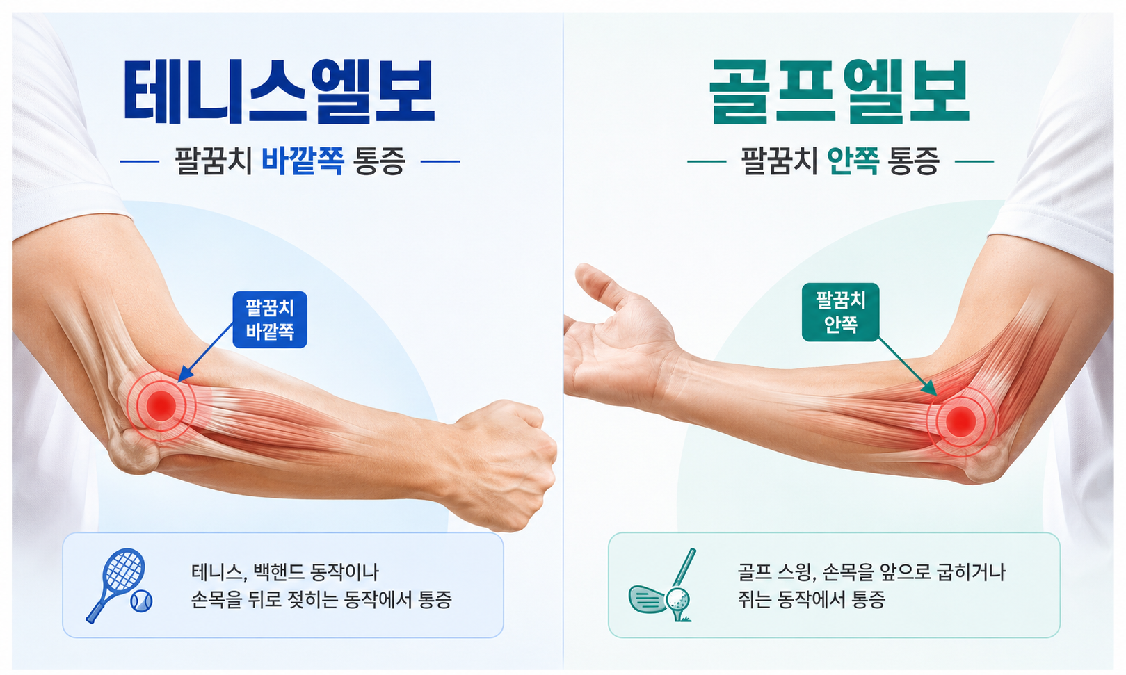 둔촌동 팔꿈치 통증 테니스엘보 골프엘보 위치 비교
